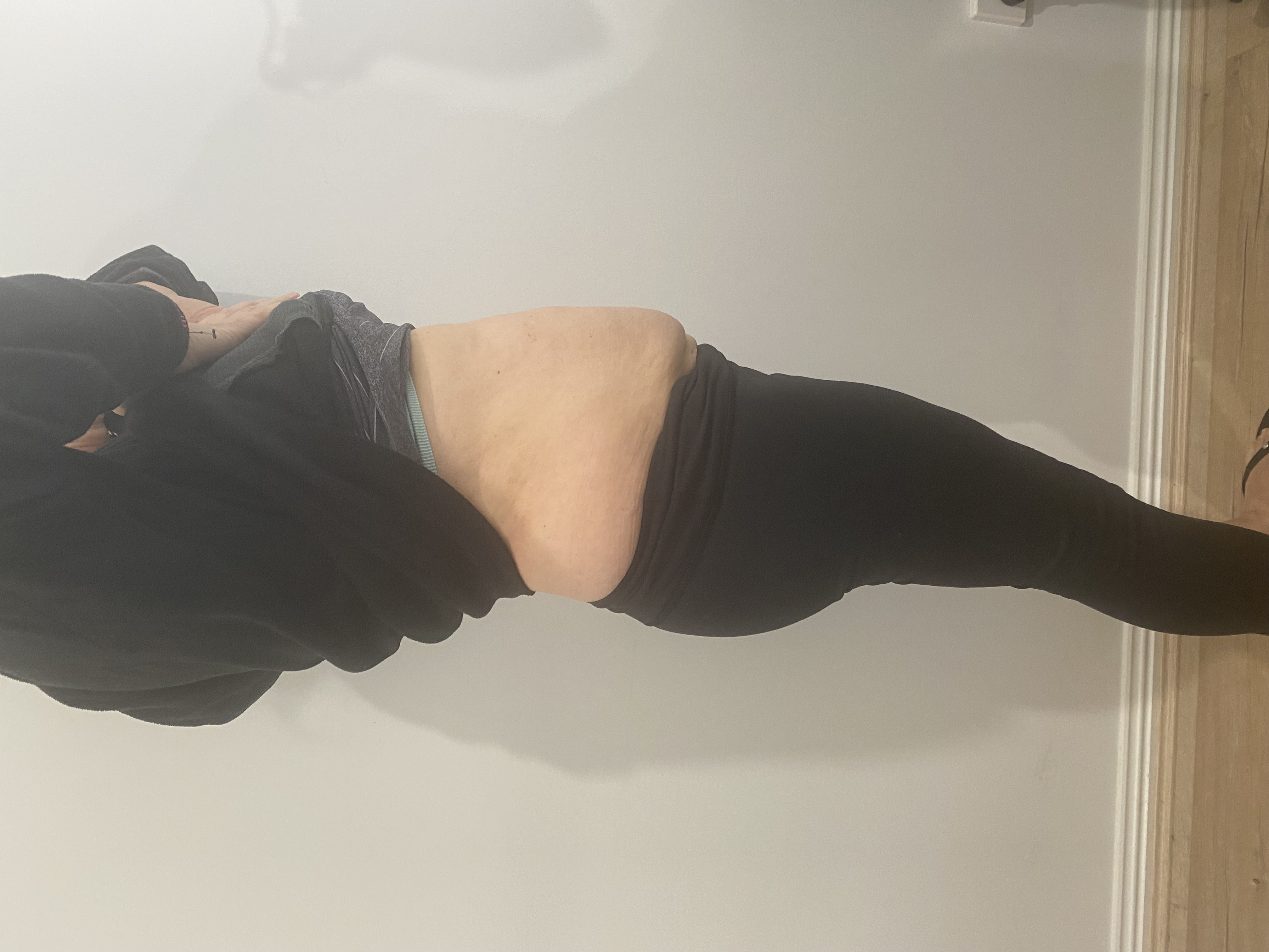 Cryolipolysis Fat Freeze After